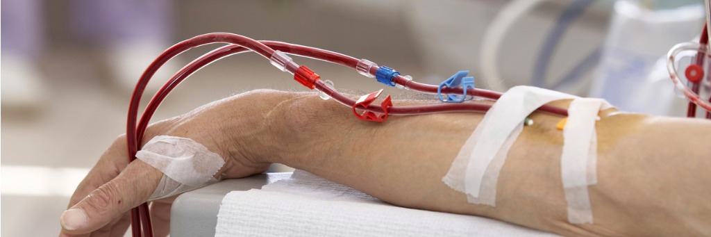 a-weekly-break-from-dialysis-is-harmful-to-people-with-kidney-failure