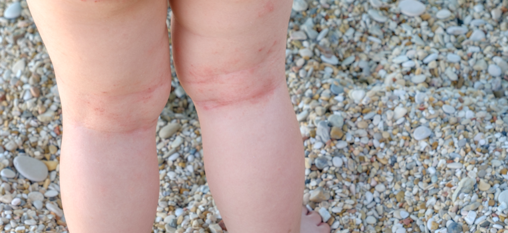 Eczema in children